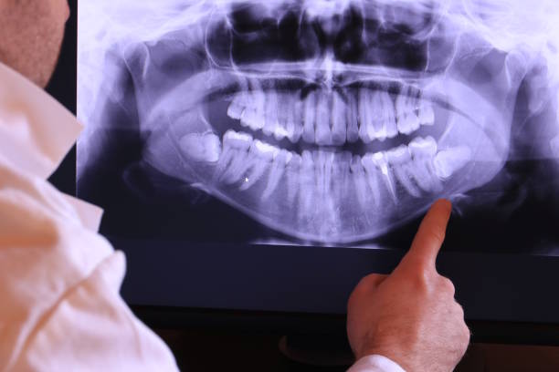 Best Emergency Tooth Extraction in Six Mile, SC