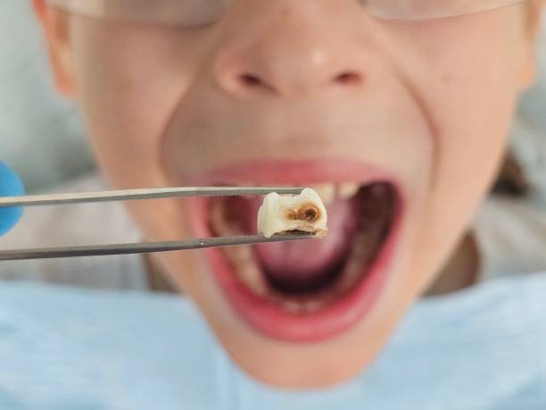 Best Emergency Treatment for Dental Infections or Abscesses in Six Mile, SC