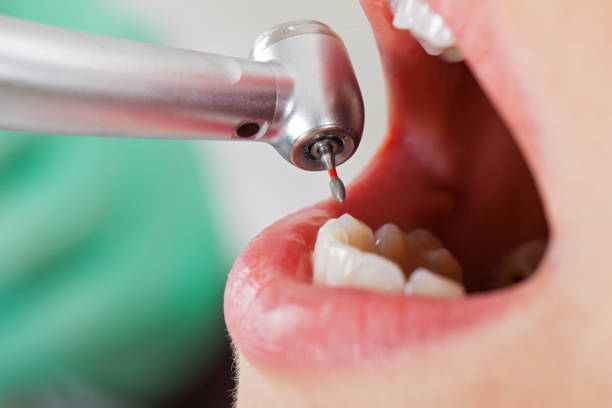 Best Emergency Tooth Extraction in Six Mile, SC